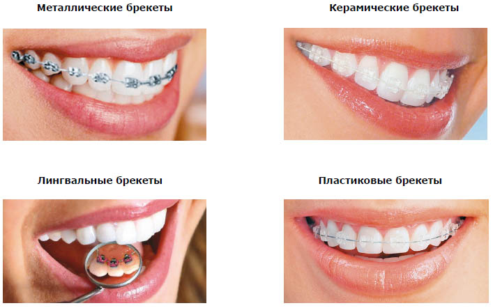 Резиновые тяги для брекетов